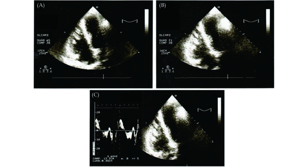 Ventricolo destro non compattato in un paziente anziano con infarto miocardico: un punto cieco diagnostico in cardiologia geriatrica